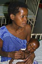 woman holding her extremely malnourished child